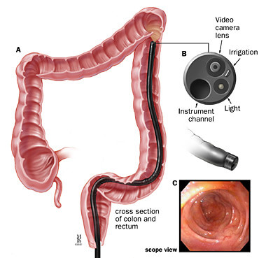 simoidoscope_colon